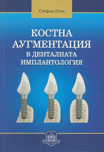 Костна аугментация в денталната имплантология