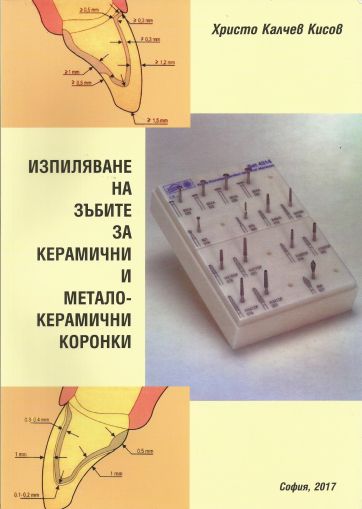 Изпиляване на зъбите за керамични и метало-керамични коронки