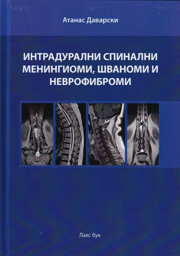 Интрадурални спинални менингиоми, шваноми и неврофиброми