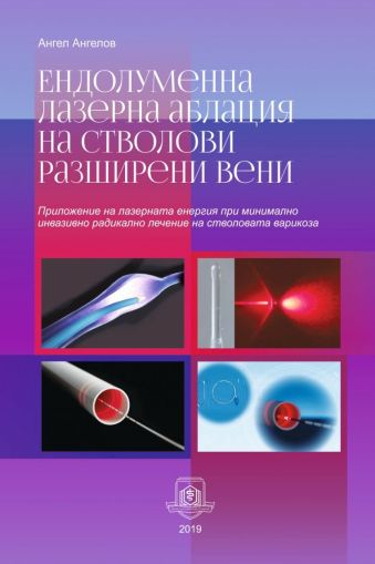  Ендолуменна лазерна аблация на стволови разширени вени